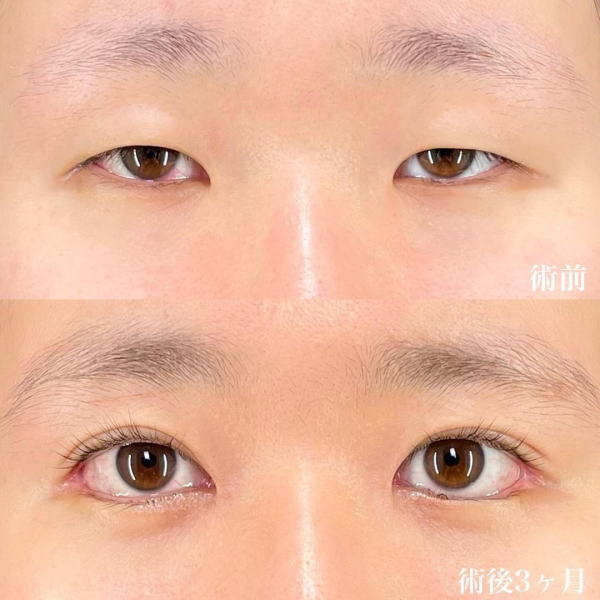 症例写真 奥二重に対して埋没法を行い、わずかに幅を広げた症例：美容外科 高須クリニック