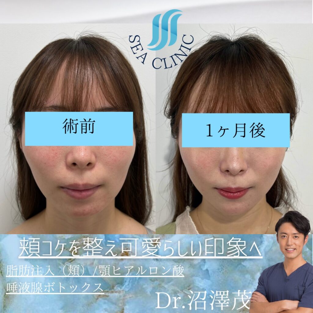 超簡単に出来る頬肉を減らす顔痩せ🔥,小顔マッサージ,小顔矯正,顔痩せ,ダイエットビフォーアフター,ライトクリニック