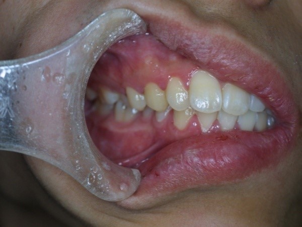 歯茎が腫れる病気と歯周病が原因だったときの対処法歯周病治療なら東京国際クリニック 歯科