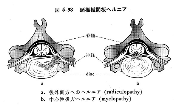 椎間板ヘルニアイラスト無料イラスト・フリー素材なら「イラストAC」