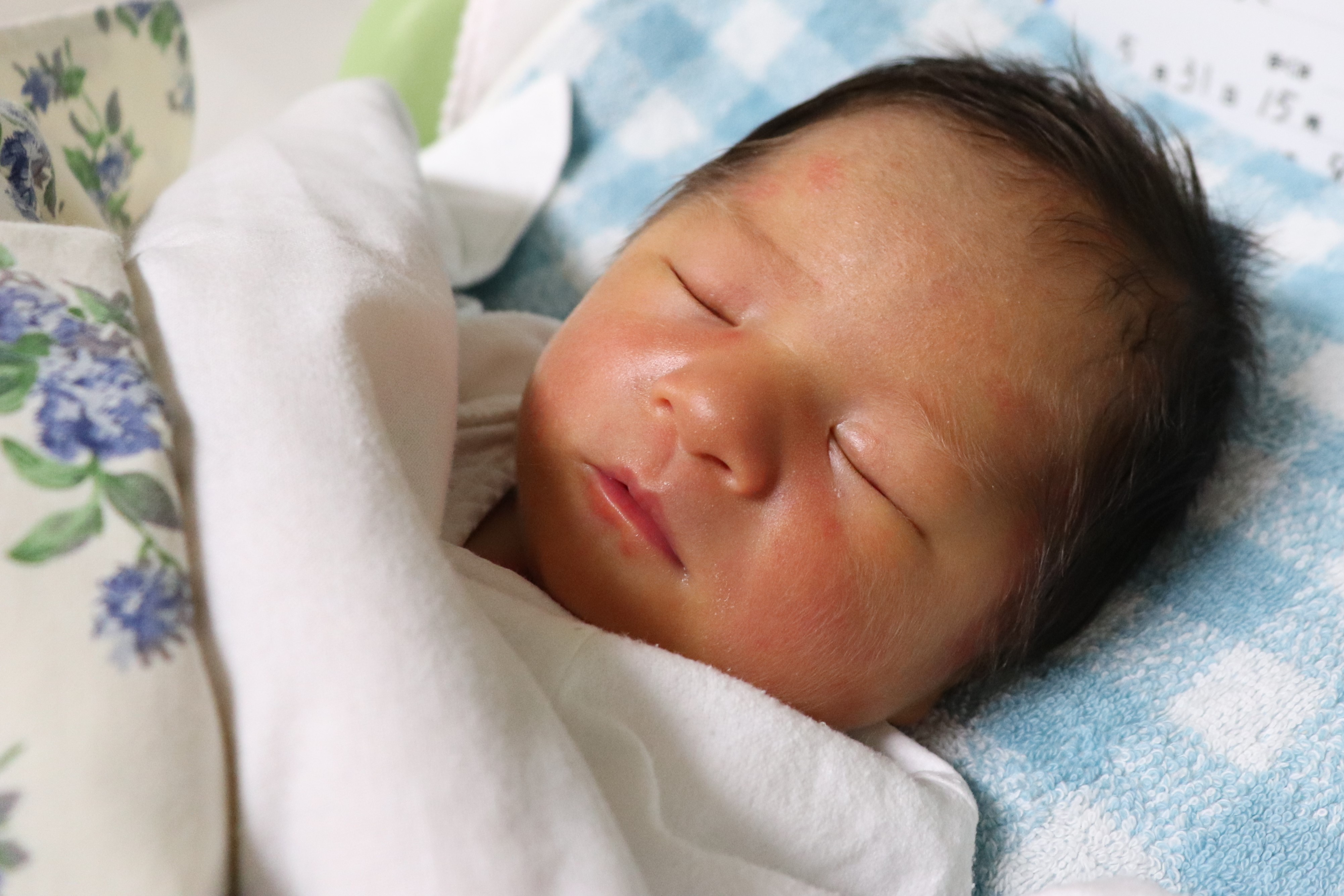 海外発！Breaking News 皮膚が黄色い「アラジール症候群」の1歳児 両親は「この病を多くの人に知ってもらいたい」 英Techinsight テックインサイト 海外セレブ、国内エンタメのオンリーワンをお届けするニュースサイト