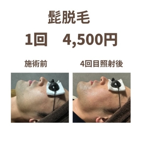 詳しく解説！あご下のヒゲを脱毛する方法とは？ -公式 メンズトータルエステサロン ZELMO ゼルモ