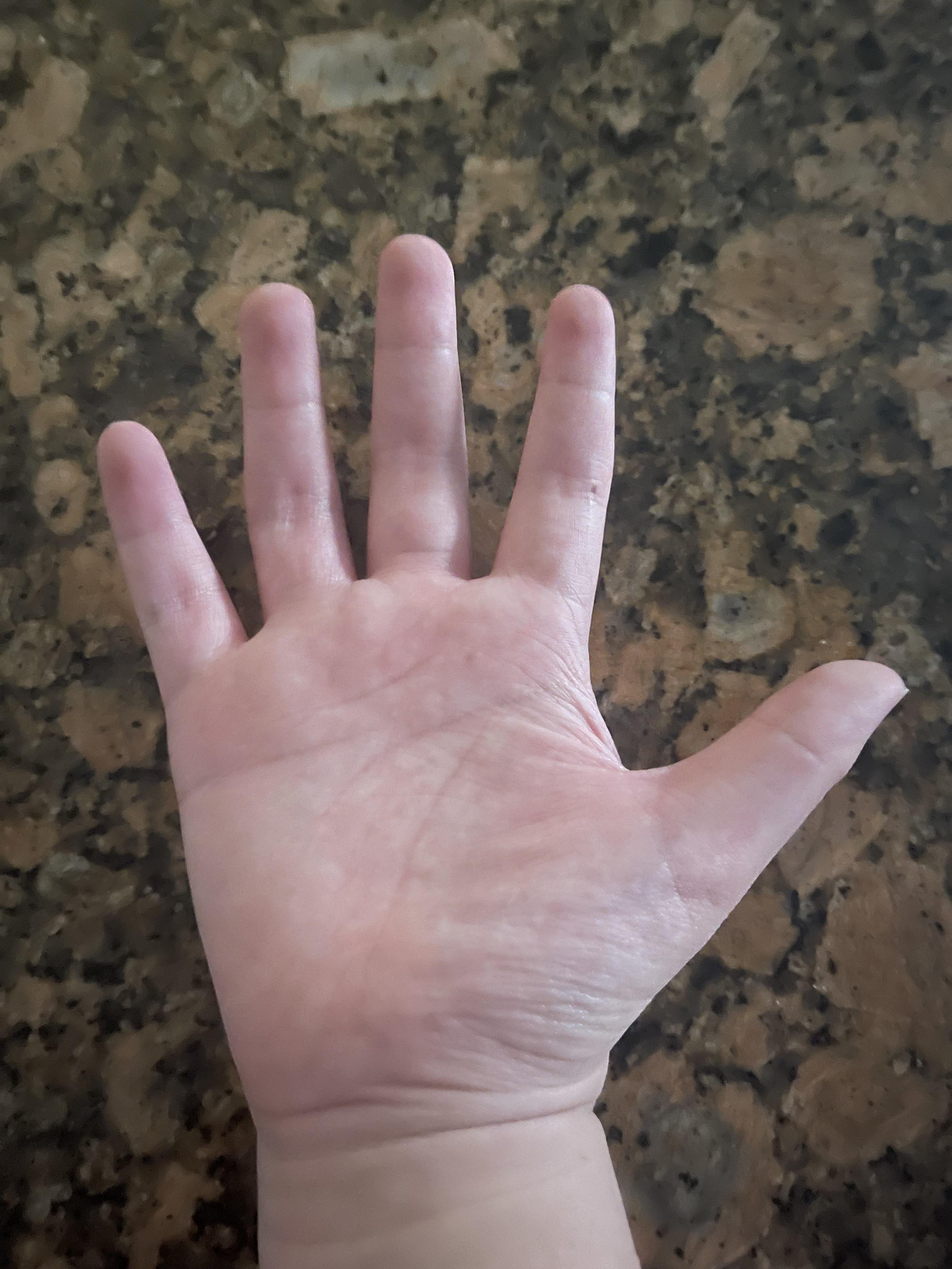 親指が短いのはなぜ？原因やコンプレックスをカバーする方法をご紹介