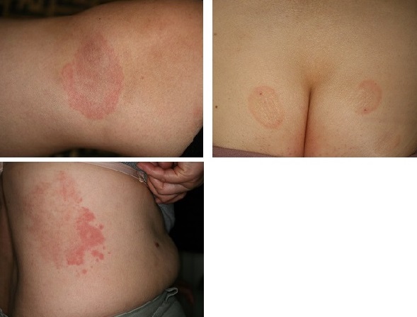 大人の蕁麻疹 じんましん 診察室でよくみる大人の病気 - みやけ内科・循環器科