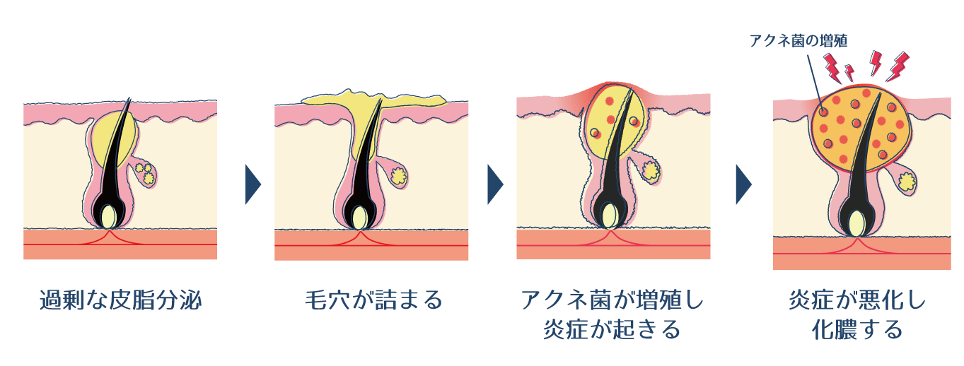 脇のブツブツの治し方とは？白い・赤い・黒いブツブツの正体も解説ハダメディア by BIHADADO.TOKYO