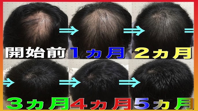 男子高校生です。 - つむじハゲてませんか？ - Yahoo!知恵袋