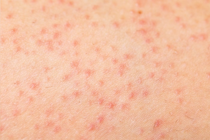 楽天市場 お尻 ニキビ 黒ずみ 魅惑のおしり プレミアム 100g 医薬部外品 おしり ブツブツ 黒ずみ 保湿 うるおい にきび クリームデリケートゾーン 美尻 ニキビケア ニキビ 引き締め 美尻 ザラザラ ボディーケア お尻 黒ずみ ブツブツ 黒ずみ 男性 ジェル : 美容のお悩み