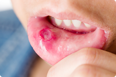 口内炎について知ろう大正製薬