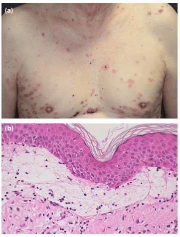 掌蹠膿疱症の病気について掌蹠膿疱症を知ろう