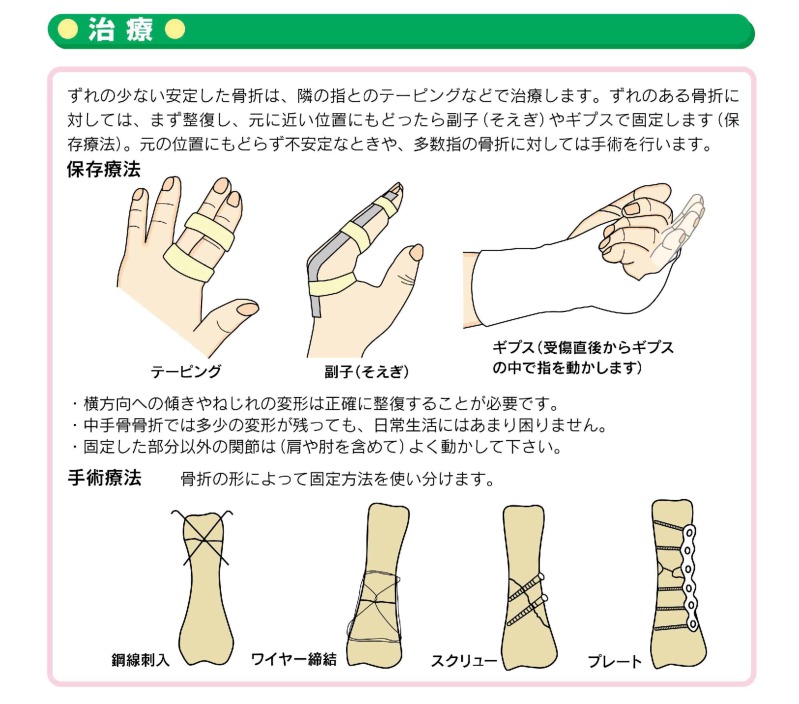 指の骨折 〜その固定、正しいですか？トラブルを避けるために〜まえだ整形外科・手のクリニック東京都杉並区にある手外科・整形外科