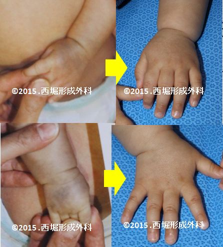 生まれつきのアザ 蒙古斑 もなかったように✨ボディメイクアップ専門店 東京DORRYART Art＆School