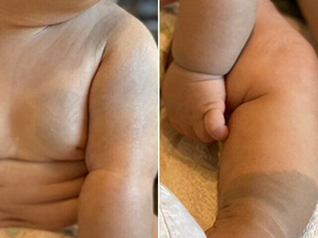 平安神宮で結婚式をされた ご新婦様は青アザ 異所性蒙古斑 や 背中ニキビ跡などを隠したいと ブライダルボディメイクを ご利用いただきました写真はお試し時のものです。 肩に蒙古斑ができておられたのですが、 打ち身の青アザと思われて心配されることが 多かった