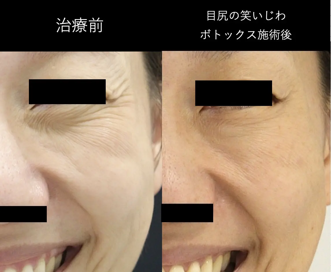 鼻のシワが気になります」の2パターンさとこ皮膚科・美容クリニック コラムサイト