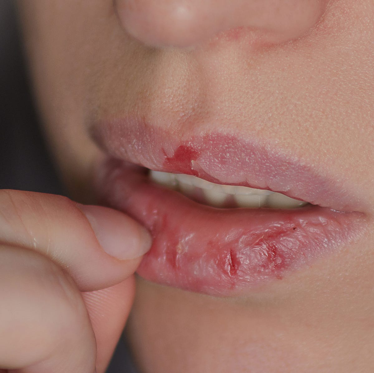 寒い冬に唇が紫色な理由はチアノーゼ？改善して治す方法は？子供は