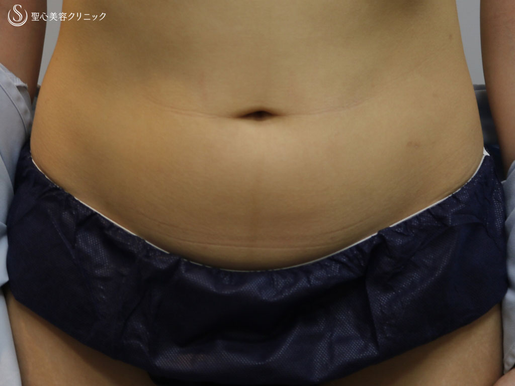 肥満だけじゃない！？女性特有の”ぽっこりお腹”の原因とスッキリ解消するための4つの習慣について血管美活