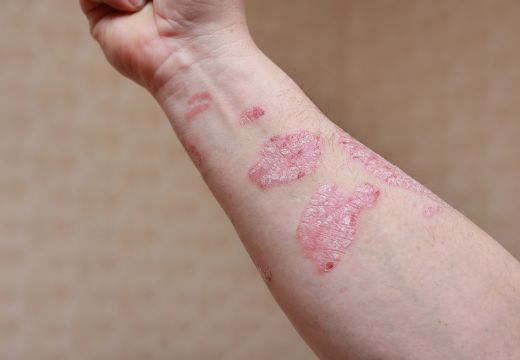 アトピー性皮膚炎 - つくば・土浦鶴町皮膚科クリニック