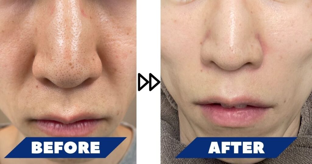 ゴリラ洗顔体験レポートハイドラフェイシャルの気になる効果と施術を公開！ - カスタムライフmedical