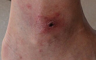 虫刺されの痕からわかる！よくある原因の虫と対処法〜皮膚科医が解説〜R形成外科皮膚科クリニック