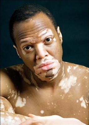 西宮市甲子園口で尋常性白斑の治療なら『あさくら皮フ科クリニック』