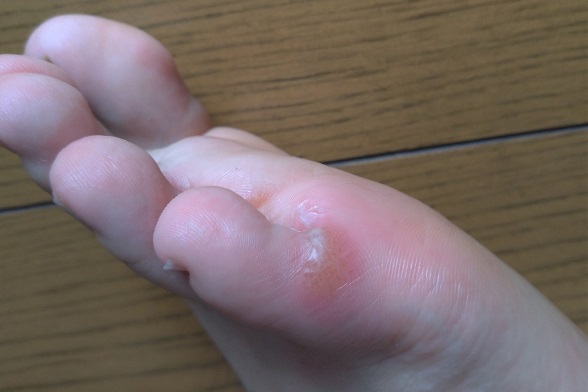 とびひ 伝染性膿痂疹 の症状とは？原因や対処法を解説治験モニター・治験バイト募集ならJCVN