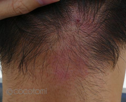 10代男性のニキビ治療5ヶ月目 内服＋面ぽう圧出パート② ニキビ治療の実績多数セイコメディカル福岡院 美容皮膚科