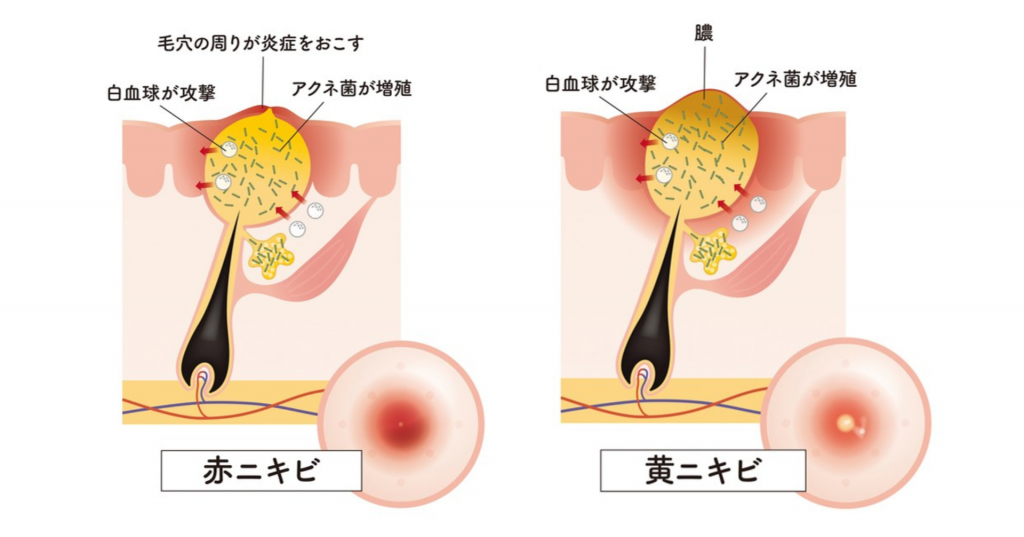 カミソリ負けが起こる原因とは？カミソリ負けしないヒゲの剃り方と対処法メンズ脱毛百科事典 リンクスペディア