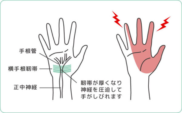 医療コラム 指のしびれや痛み、「手根症候群」かもしれません。 – 函館五稜郭病院