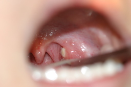 扁桃腺が腫れていたりすると, 鼻が詰まりやすくなったり, 口呼吸になったり, して, さらなる悪化をする可能性があります。, 扁桃腺を切除する,方法 耳鼻科で もありますが, そこまでではない場合, 舌や口のトレーニングで, 改善するケースもあります, ぜひ一度,歯医者さんにご相談くださいね, 3歳になったらVキッズを始めよう！,