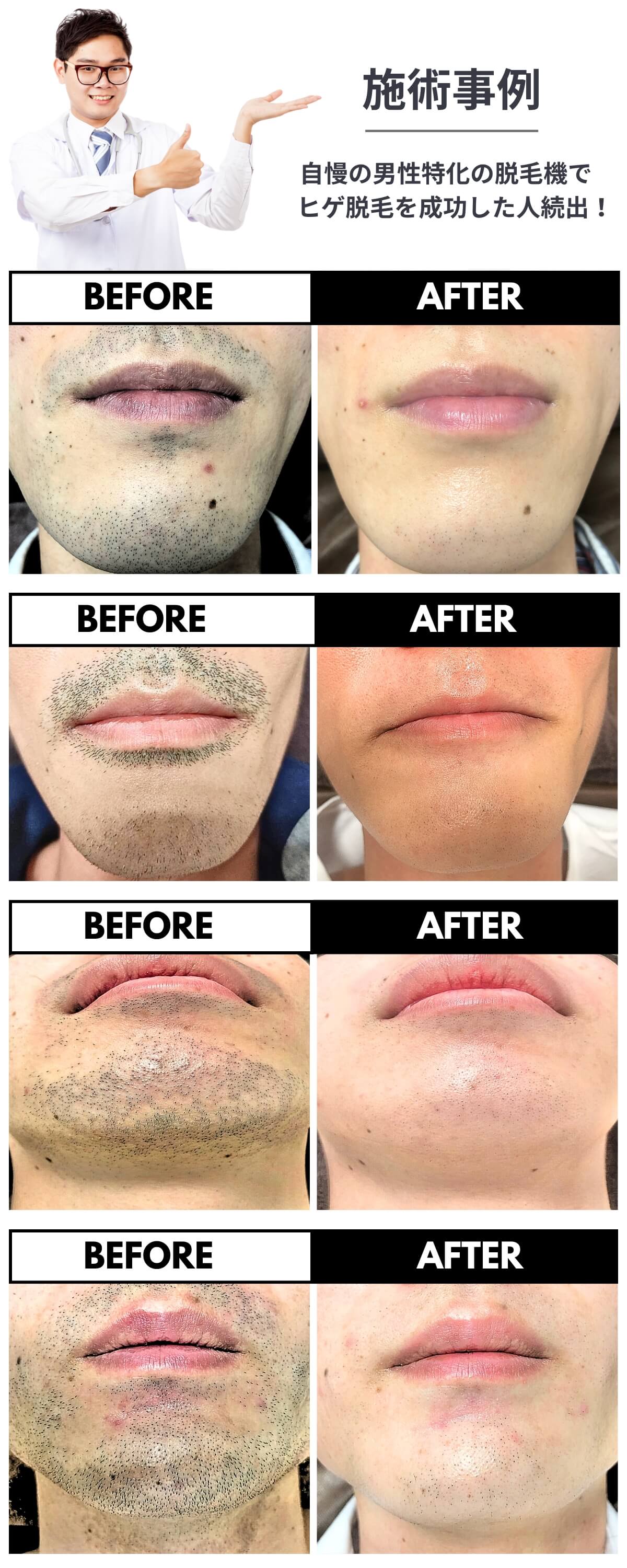 男性のヒゲ脱毛美容皮膚科エルムクリニック