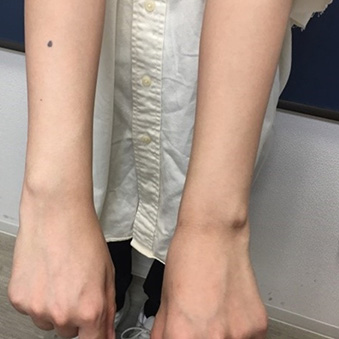 点滴後の内出血の写真・画像素材-Snapmart スナップマート