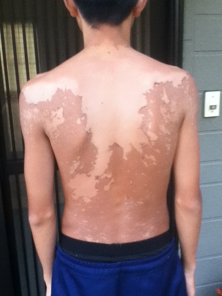 あばれる君の痛々しい日焼け、背中の皮が激しくむけた姿に心配の声。記事画像 photo2 2016-04-02-044959Narinari.com