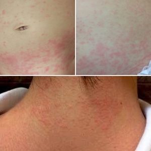 汗も野田市 小児科 千葉県 こどもの花粉症 こどもの漢方 喘息 アトピー性皮膚炎 アレルギー 結節性痒疹 たんぽぽこどもクリニック