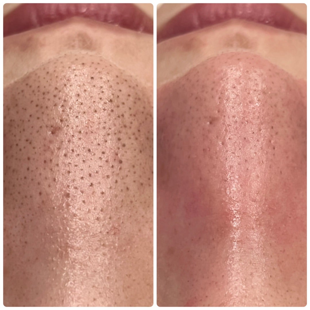 神回 １日でいちご鼻を抹殺した最強毛穴特別スキンケア！！！！！￥2000円以下！ドラックストア！ Qoo10