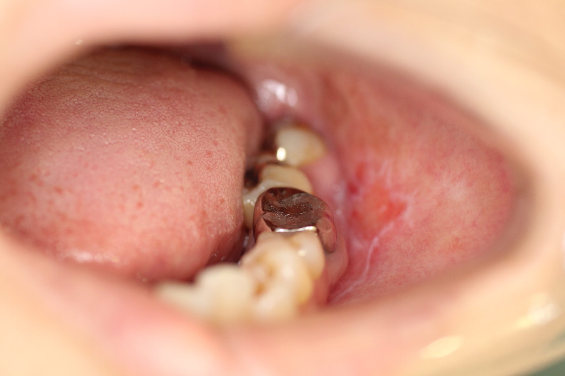 扁平苔癬」の1191点のロイヤリティフリー画像、写真素材、絵Shutterstock