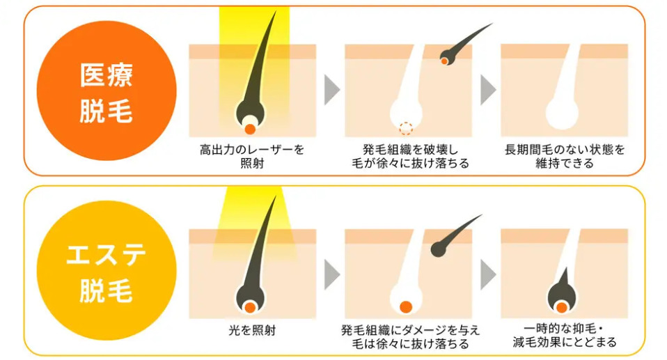 じぶんクリニックの医療脱毛！料金•機械の選び方を徹底解説 医師監修2025年最新版