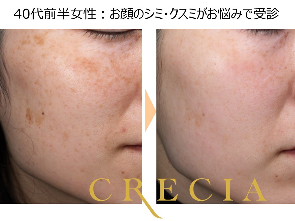 シミ治療で失敗しないためにピコレーザーでシミ取りをする時の美容皮膚科の選び方水の森美容クリニック 美容皮膚科