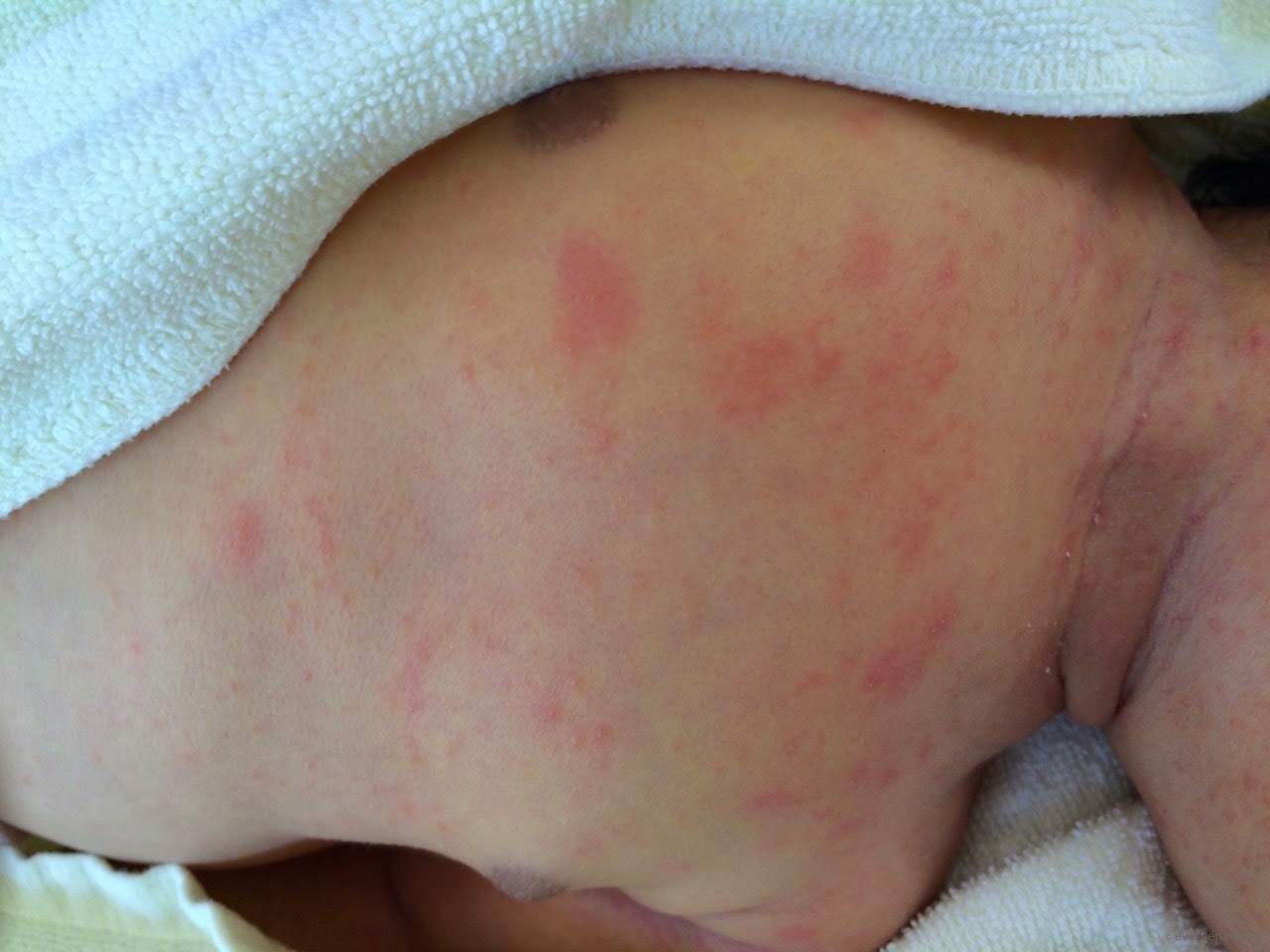 乳児湿疹の原因とケア方法ベビースマイル 赤ちゃんの健康情報