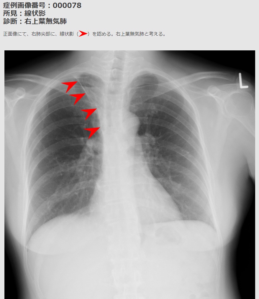 シリーズ呼吸器外科 1 気胸呼吸器外科中頭病院