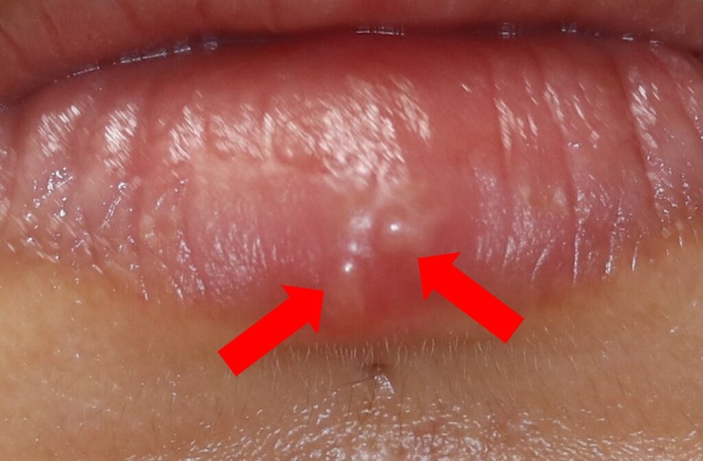 口唇ヘルペスは、白い背景で隔離された女性の下唇に発生します。壊れて小さな潰瘍、リンパ節の腫れを形成する水疱。単純ヘルペスウイルスは、ヘルペスを引き起こす感染症です。の写真素材・画像素材Image 179259374