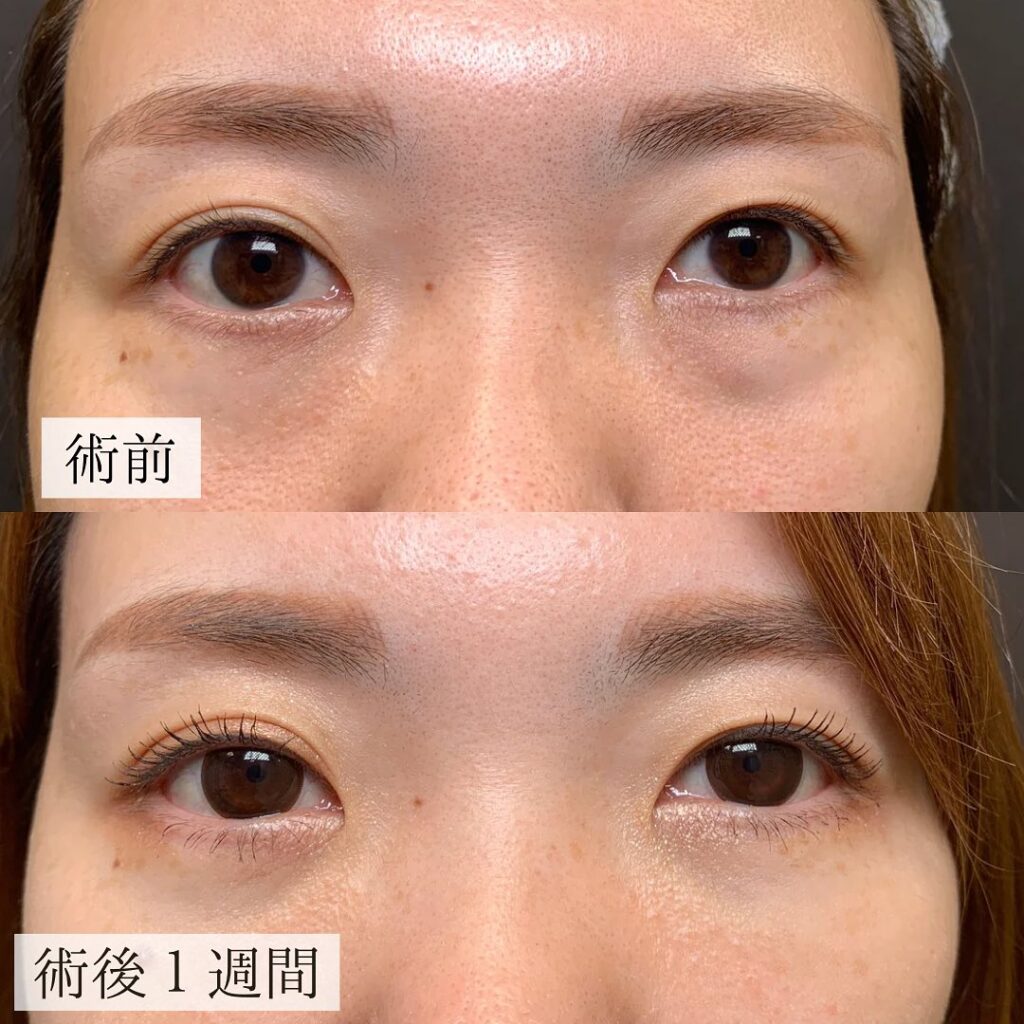 目の下のたるみを取る方法はある？自力で治すのは可能？原因と対策を徹底解説 - カスタムライフmedical