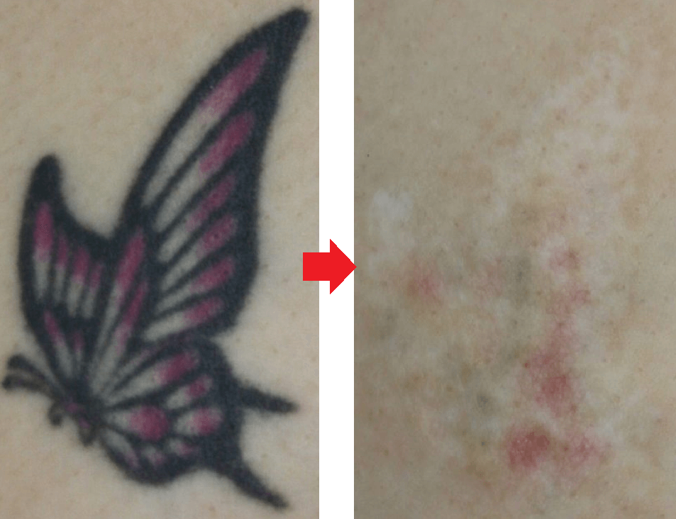 タトゥーの彫り方 ストローカータトゥー横浜の舞台裏