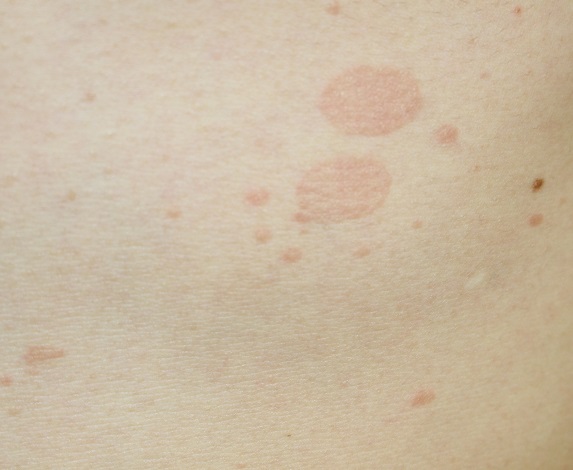 白癬』の原因・症状・治療法 症例画像 田辺三菱製薬ヒフノコトサイト