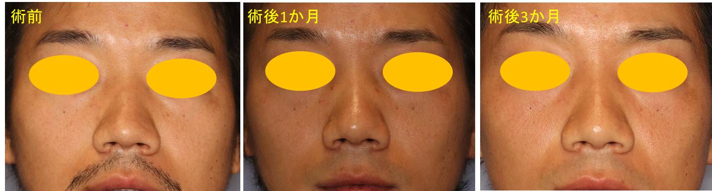 曲がった鼻・斜鼻の治療を、２ステップで”目で見て”理解する
