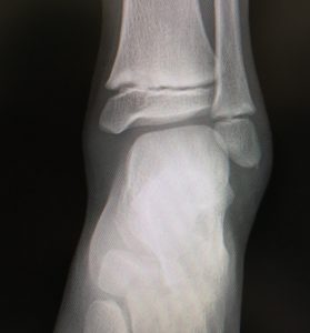 骨端線とは？手のレントゲン画像から身長を予測！医療法人社団 東整会 東京神田整形外科クリニック