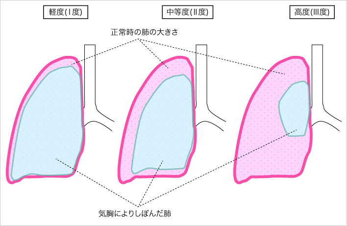 無気肺について横浜弘明寺呼吸器内科クリニック健康情報局