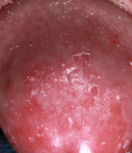 デリケートゾーンの粉瘤 しこり、できもの 治療について専門医が徹底解説東京皮膚のできものと粉瘤クリニック ふるばやし形成外科 新宿院