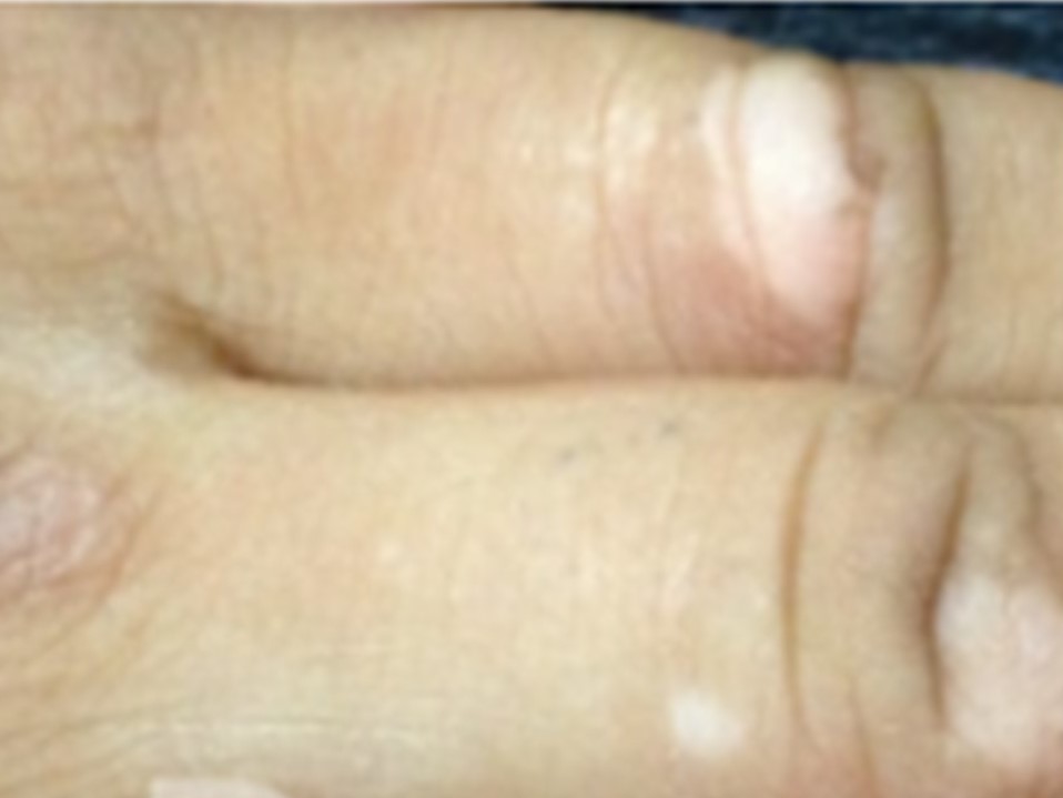 尋常性白斑は治った人がいる？自然治癒から最新治療まで徹底解説治験モニターのススメ