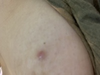 頬ニキビの原因と治し方 跡を残さずキレイに治療するには？ -東京4院・大阪3院 美容皮膚科フェミークリニック