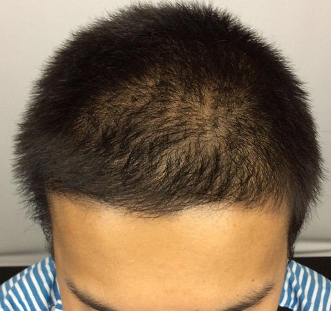 つむじハゲの基準はどこから？見分け方や上手な隠し方を解説！hagerico スーパースカルプ発毛センター