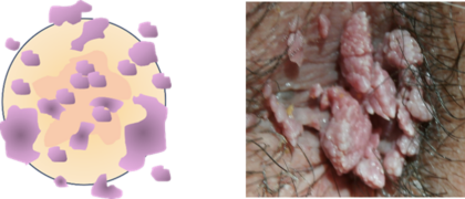 尖圭コンジローマの症状・画像・感染経路・治療について東京都新橋駅徒歩1分のの泌尿器科クリニック